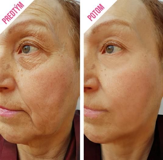 Ohromující výsledky před a po 2 týdnech používání krému proti vráskám.